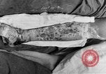 Image of eye injuries from gas attack during World War I France, 1918, second 59 stock footage video 65675042405