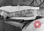 Image of eye injuries from gas attack during World War I France, 1918, second 61 stock footage video 65675042405