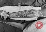 Image of eye injuries from gas attack during World War I France, 1918, second 62 stock footage video 65675042405
