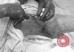 Standbild Die Abdominal- wunde Chirurgie auf Ersten Weltkrieg Soldat Frankreich, 1918, aus Sekunde 3 historischem Filmmaterial Videoclip 65675042421