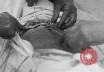 Standbild Die Abdominal- wunde Chirurgie auf Ersten Weltkrieg Soldat Frankreich, 1918, aus Sekunde 4 historischem Filmmaterial Videoclip 65675042421