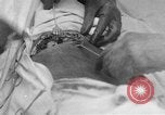 Standbild Die Abdominal- wunde Chirurgie auf Ersten Weltkrieg Soldat Frankreich, 1918, aus Sekunde 5 historischem Filmmaterial Videoclip 65675042421