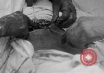 Standbild Die Abdominal- wunde Chirurgie auf Ersten Weltkrieg Soldat Frankreich, 1918, aus Sekunde 7 historischem Filmmaterial Videoclip 65675042421