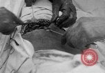 Standbild Die Abdominal- wunde Chirurgie auf Ersten Weltkrieg Soldat Frankreich, 1918, aus Sekunde 9 historischem Filmmaterial Videoclip 65675042421