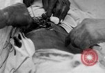 Standbild Die Abdominal- wunde Chirurgie auf Ersten Weltkrieg Soldat Frankreich, 1918, aus Sekunde 19 historischem Filmmaterial Videoclip 65675042421