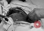 Standbild Die Abdominal- wunde Chirurgie auf Ersten Weltkrieg Soldat Frankreich, 1918, aus Sekunde 21 historischem Filmmaterial Videoclip 65675042421