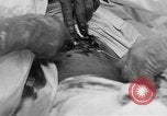 Standbild Die Abdominal- wunde Chirurgie auf Ersten Weltkrieg Soldat Frankreich, 1918, aus Sekunde 33 historischem Filmmaterial Videoclip 65675042421
