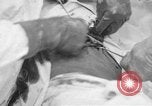 Standbild Die Abdominal- wunde Chirurgie auf Ersten Weltkrieg Soldat Frankreich, 1918, aus Sekunde 42 historischem Filmmaterial Videoclip 65675042421