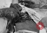 Standbild Die Abdominal- wunde Chirurgie auf Ersten Weltkrieg Soldat Frankreich, 1918, aus Sekunde 43 historischem Filmmaterial Videoclip 65675042421