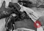 Standbild Die Abdominal- wunde Chirurgie auf Ersten Weltkrieg Soldat Frankreich, 1918, aus Sekunde 44 historischem Filmmaterial Videoclip 65675042421