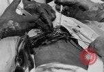 Standbild Die Abdominal- wunde Chirurgie auf Ersten Weltkrieg Soldat Frankreich, 1918, aus Sekunde 46 historischem Filmmaterial Videoclip 65675042421