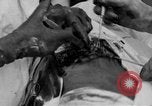 Standbild Die Abdominal- wunde Chirurgie auf Ersten Weltkrieg Soldat Frankreich, 1918, aus Sekunde 47 historischem Filmmaterial Videoclip 65675042421