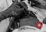 Standbild Die Abdominal- wunde Chirurgie auf Ersten Weltkrieg Soldat Frankreich, 1918, aus Sekunde 48 historischem Filmmaterial Videoclip 65675042421