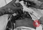 Standbild Die Abdominal- wunde Chirurgie auf Ersten Weltkrieg Soldat Frankreich, 1918, aus Sekunde 49 historischem Filmmaterial Videoclip 65675042421