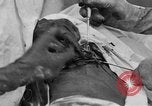 Standbild Die Abdominal- wunde Chirurgie auf Ersten Weltkrieg Soldat Frankreich, 1918, aus Sekunde 51 historischem Filmmaterial Videoclip 65675042421