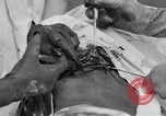Standbild Die Abdominal- wunde Chirurgie auf Ersten Weltkrieg Soldat Frankreich, 1918, aus Sekunde 52 historischem Filmmaterial Videoclip 65675042421