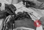 Standbild Die Abdominal- wunde Chirurgie auf Ersten Weltkrieg Soldat Frankreich, 1918, aus Sekunde 53 historischem Filmmaterial Videoclip 65675042421
