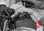 Standbild Die Abdominal- wunde Chirurgie auf Ersten Weltkrieg Soldat Frankreich, 1918, aus Sekunde 55 historischem Filmmaterial Videoclip 65675042421