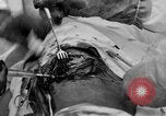 Standbild Die Abdominal- wunde Chirurgie auf Ersten Weltkrieg Soldat Frankreich, 1918, aus Sekunde 57 historischem Filmmaterial Videoclip 65675042421