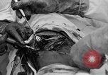Standbild Die Abdominal- wunde Chirurgie auf Ersten Weltkrieg Soldat Frankreich, 1918, aus Sekunde 59 historischem Filmmaterial Videoclip 65675042421