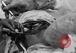 Standbild Die Abdominal- wunde Chirurgie auf Ersten Weltkrieg Soldat Frankreich, 1918, aus Sekunde 61 historischem Filmmaterial Videoclip 65675042421