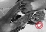 Image of leg surgery on wounded soldier France, 1918, second 43 stock footage video 65675042425
