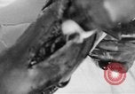 Image of leg surgery on wounded soldier France, 1918, second 50 stock footage video 65675042425