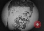 Image of injured soldier France, 1918, second 42 stock footage video 65675042433