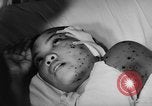 Image of wounded patients Vietnam, 1962, second 12 stock footage video 65675046660
