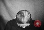 Image of microscopic view of skin Hiroshima Japan, 1945, second 21 stock footage video 65675052709