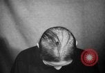 Image of microscopic view of skin Hiroshima Japan, 1945, second 22 stock footage video 65675052709