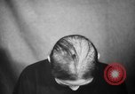 Image of microscopic view of skin Hiroshima Japan, 1945, second 24 stock footage video 65675052709