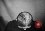 Image of microscopic view of skin Hiroshima Japan, 1945, second 26 stock footage video 65675052709