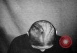 Image of microscopic view of skin Hiroshima Japan, 1945, second 27 stock footage video 65675052709