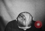 Image of microscopic view of skin Hiroshima Japan, 1945, second 29 stock footage video 65675052709