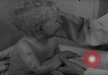 Standbild Kinder mit Haut Infektionen Deutschland, 1946, aus Sekunde 7 historischem Filmmaterial Videoclip 65675056080