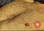 Standbild italienischen Patienten Neapel Italien, 1944, aus Sekunde 39 historischem Filmmaterial Videoclip 65675060292