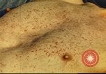 Standbild italienischen Patienten Neapel Italien, 1944, aus Sekunde 40 historischem Filmmaterial Videoclip 65675060292