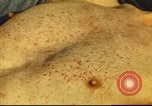 Standbild italienischen Patienten Neapel Italien, 1944, aus Sekunde 41 historischem Filmmaterial Videoclip 65675060292