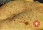 Standbild italienischen Patienten Neapel Italien, 1944, aus Sekunde 42 historischem Filmmaterial Videoclip 65675060292