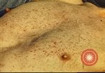 Standbild italienischen Patienten Neapel Italien, 1944, aus Sekunde 43 historischem Filmmaterial Videoclip 65675060292