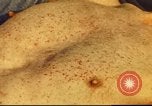 Standbild italienischen Patienten Neapel Italien, 1944, aus Sekunde 45 historischem Filmmaterial Videoclip 65675060292