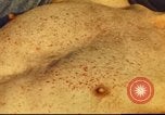 Standbild italienischen Patienten Neapel Italien, 1944, aus Sekunde 46 historischem Filmmaterial Videoclip 65675060292