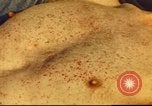 Standbild italienischen Patienten Neapel Italien, 1944, aus Sekunde 47 historischem Filmmaterial Videoclip 65675060292