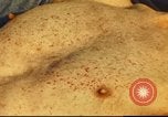 Standbild italienischen Patienten Neapel Italien, 1944, aus Sekunde 48 historischem Filmmaterial Videoclip 65675060292