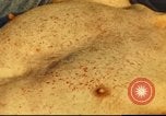 Standbild italienischen Patienten Neapel Italien, 1944, aus Sekunde 49 historischem Filmmaterial Videoclip 65675060292