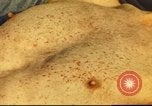 Standbild italienischen Patienten Neapel Italien, 1944, aus Sekunde 51 historischem Filmmaterial Videoclip 65675060292