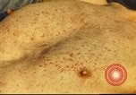 Standbild italienischen Patienten Neapel Italien, 1944, aus Sekunde 52 historischem Filmmaterial Videoclip 65675060292