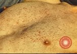 Standbild italienischen Patienten Neapel Italien, 1944, aus Sekunde 53 historischem Filmmaterial Videoclip 65675060292