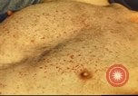 Standbild italienischen Patienten Neapel Italien, 1944, aus Sekunde 54 historischem Filmmaterial Videoclip 65675060292
